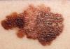 Melanoma on the skin Melanoma on the skin