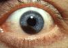 Melanoma in an iris Melanoma in an iris