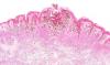 Melanoma Microscope Melanoma Microscope